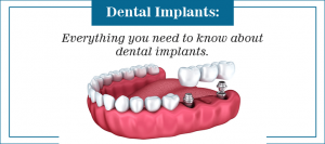Dental Implants: What You Need To Know Before You Go