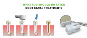 What You Should Do After Root Canal Treatment?