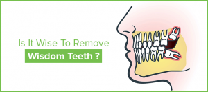 Is It Wise To Remove Wisdom Teeth
