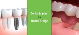 Dental Implants vs Dental Bridges