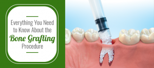 Everything You Need to Know About the Bone Grafting Procedure