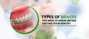 Types of Braces You Need to Know Before Visiting Your Dentist