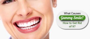 What Causes Gummy Smile? How to Get Rid of It?