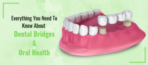 Everything you need to know about Dental Bridges and Oral Health 7