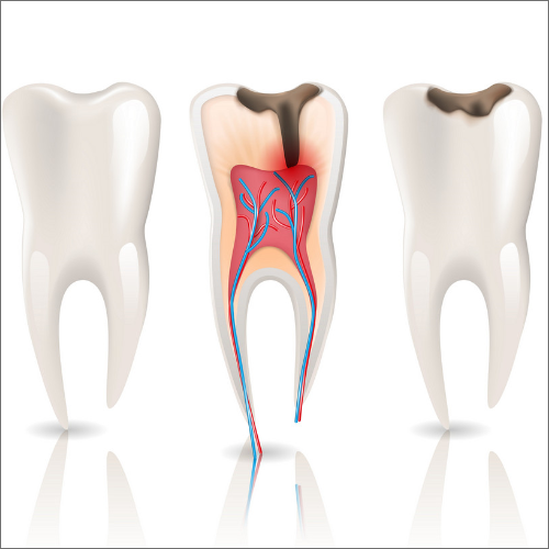 Symptoms of root canal 1