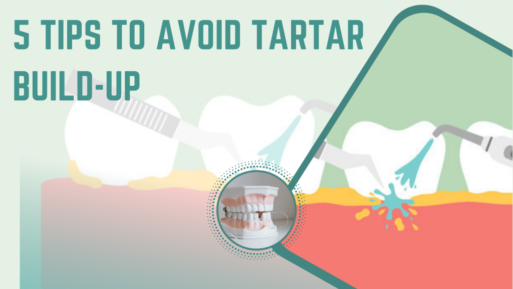 5 Tips To Avoid Tartar Buildup Creative Dental Clinic